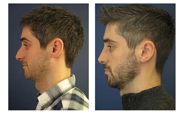 Rhinoplasty