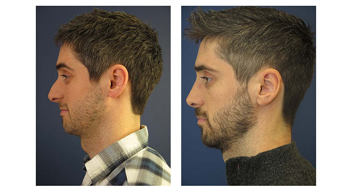 Close-up profile illustrating facial proportion in rhinoplasty planning
